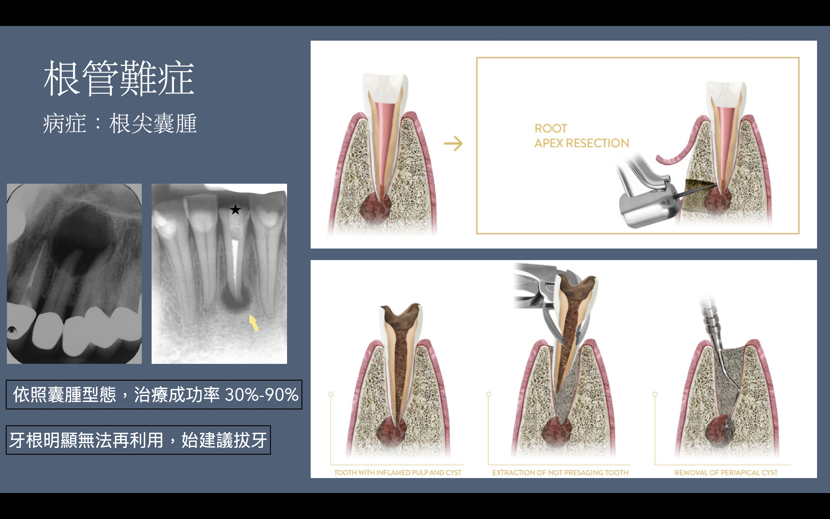 牙齒根部長了「囊腫」?什麼是根尖囊腫? – 胡信彰牙醫師衛教網